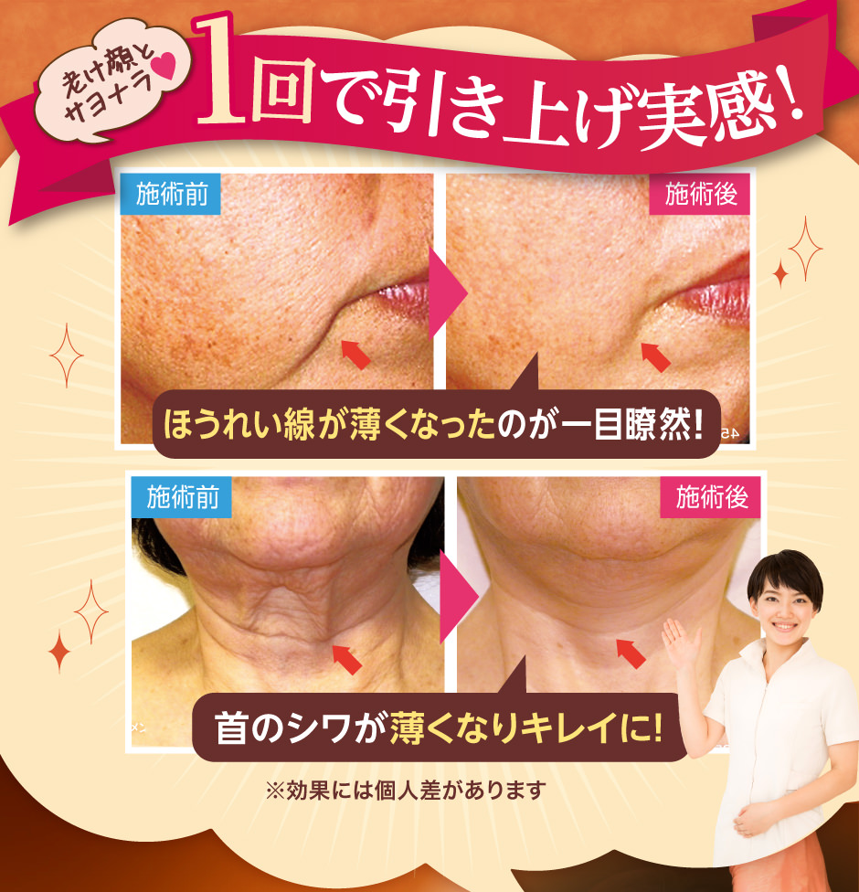 1老け顔とサヨナラ♥回で引き上げ実感！ほうれい線が薄くなったのが一目瞭然！首のシワが薄くなりキレイに！